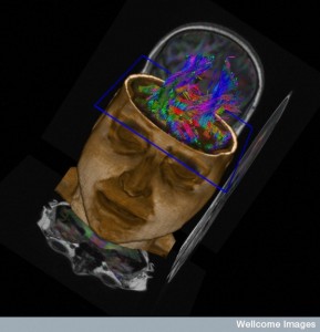 Brain Tractography: Visualising Neuronal Tracts                                                                          